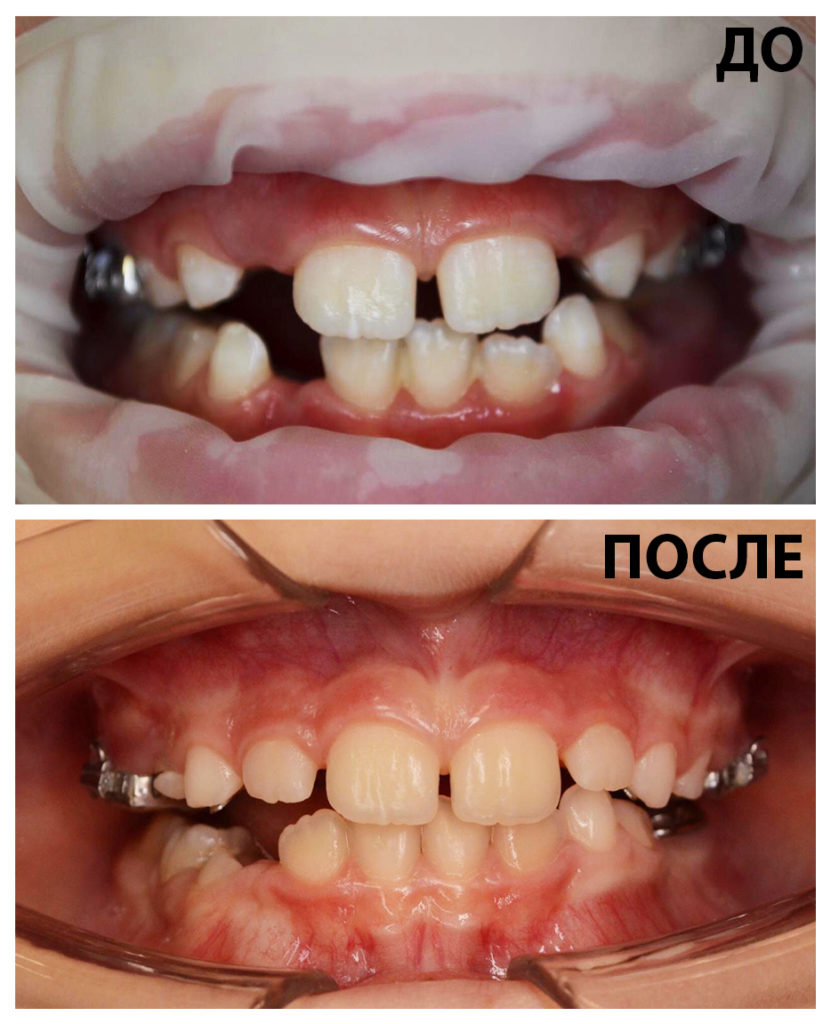 Лечение сужения зубного ряда - Ортодонтия в Дзержинске | Клиника 